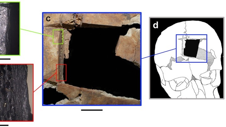 Ο άνθρωπος με μια τετράγωνη τρύπα στο κρανίο του: Ένδειξη για χειρουργική εγκεφάλου πριν 3.500 χρόνια στο Ισραήλ